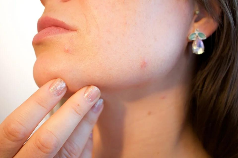 Follow These Hints To Eliminate Acne Now!